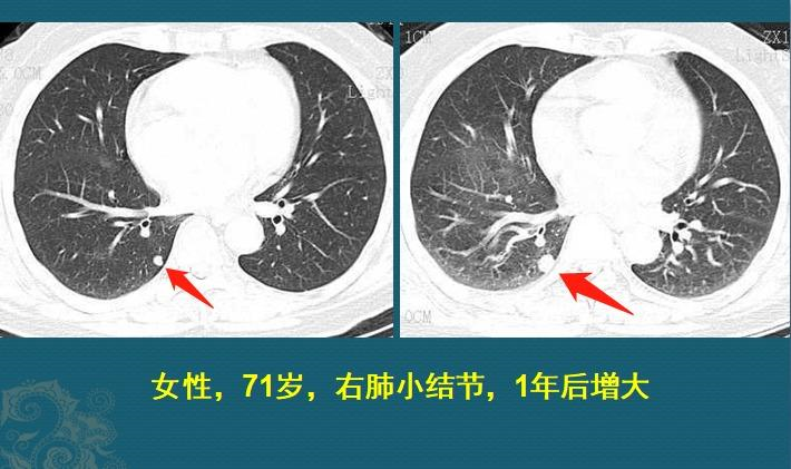 粘液实验室3怎么下载（影像科的真相：粘液腺癌细胞会伪装，医生教你用CT扫描抓“贼”）-第7张图片-拓城游