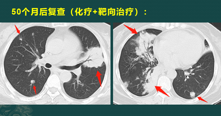 粘液实验室3怎么下载（影像科的真相：粘液腺癌细胞会伪装，医生教你用CT扫描抓“贼”）-第5张图片-拓城游