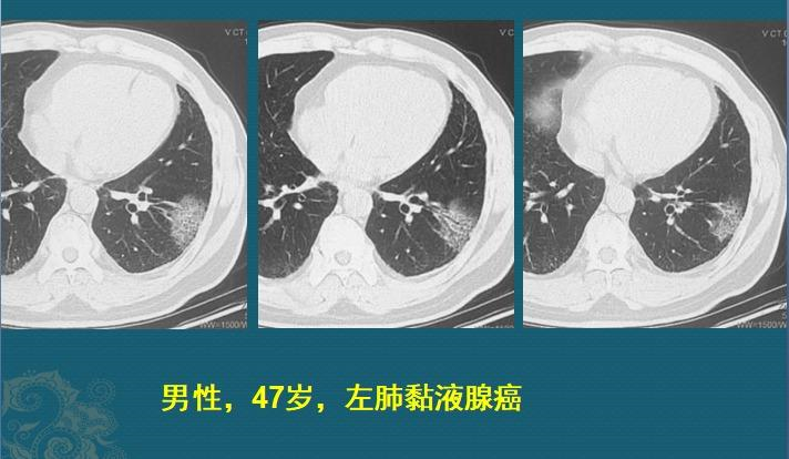 粘液实验室3怎么下载（影像科的真相：粘液腺癌细胞会伪装，医生教你用CT扫描抓“贼”）-第10张图片-拓城游