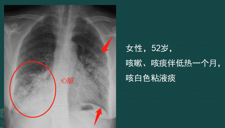 粘液实验室3怎么下载（影像科的真相：粘液腺癌细胞会伪装，医生教你用CT扫描抓“贼”）-第2张图片-拓城游