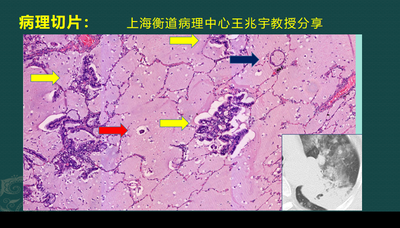 粘液实验室3怎么下载（影像科的真相：粘液腺癌细胞会伪装，医生教你用CT扫描抓“贼”）-第4张图片-拓城游