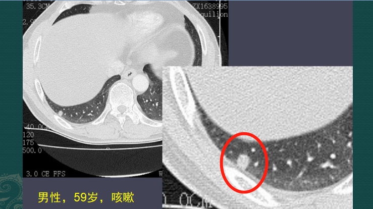 粘液实验室3怎么下载（影像科的真相：粘液腺癌细胞会伪装，医生教你用CT扫描抓“贼”）-第8张图片-拓城游